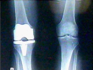 RADIOGRAFIA RODILLA 2 · IMAGENES FOTOS